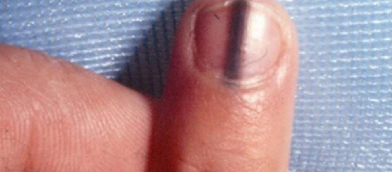 Μαύρη γραμμή στο νύχι: Ποιες είναι οι αιτίες; - Τι θεραπεία υπάρχει;